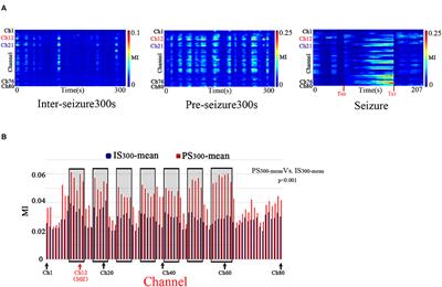 Phase–Amplitude Coupling and Epileptogenic Zone Localization of Frontal Epilepsy Based on Intracranial EEG